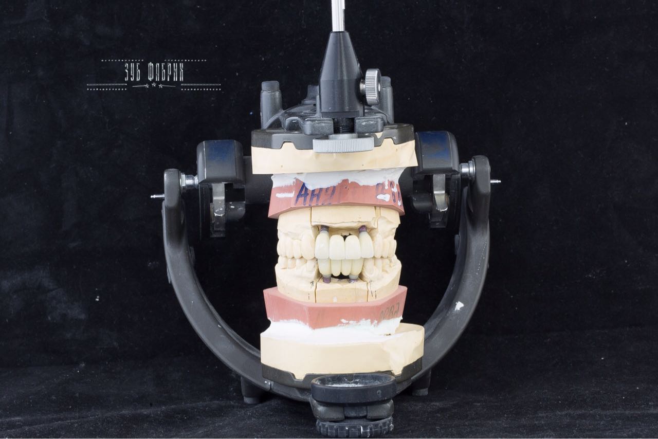 Протезирование по технологии All on 4 all in 4 протезирование